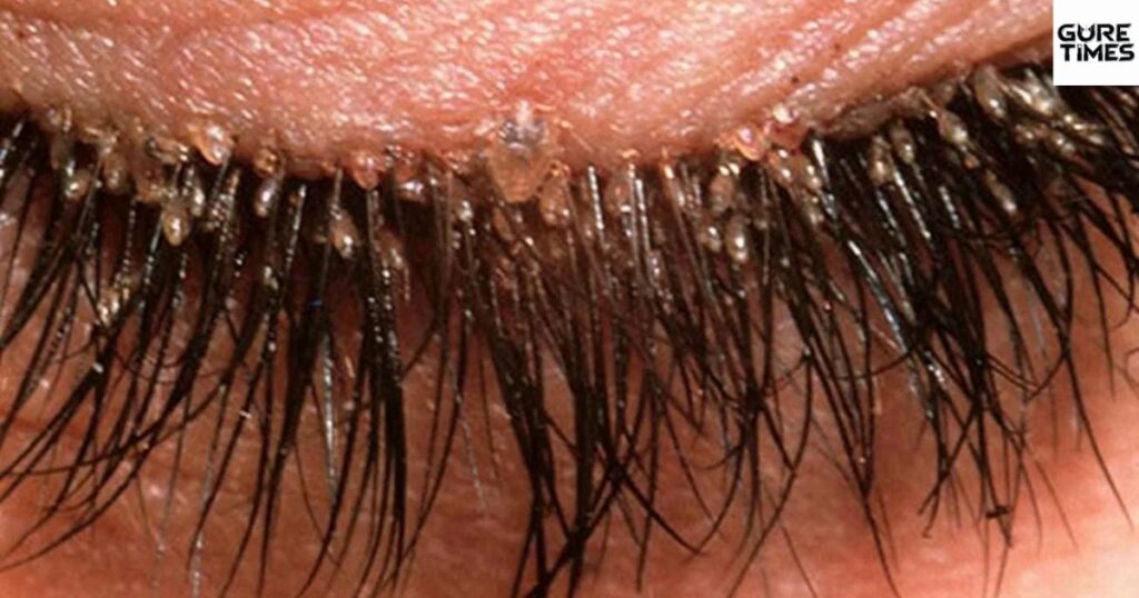 What are Eyelash Extension Mites?